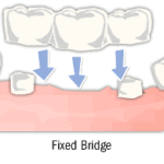 fixed-bridge